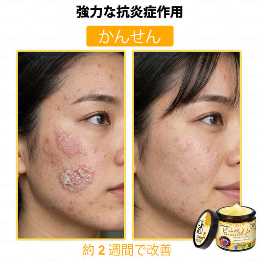 ✨💜💜APKAPK® 𝗠É𝗛𝗠É𝗥𝗘𝗚 総合クリーム🥇 皮膚の隆起に対するケアには以下が含まれます: 加齢によるシミ、傷跡、いぼ、皮膚の隆起、脂肪の塊、ニキビ、湿疹、乾癬、反転性ニキビ、しわ、皮膚の老化およびその他の問題🔥
